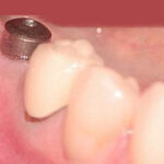 cuanto-cuesta-un-implante-dental-en-estados-unidos